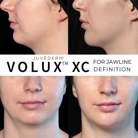 juvederm volux review.